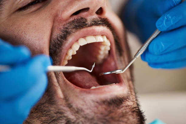 Best Emergency Dentist for Knocked-Out Tooth in Carter Lake, IA